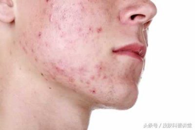 ​青春痘疤痕怎么治疗 不同类型痘印选择不同治疗