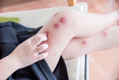 ​蚊子咬了怎么消肿止痒最快小妙招（被蚊子咬后，又痒又难受！看看这4个“快速