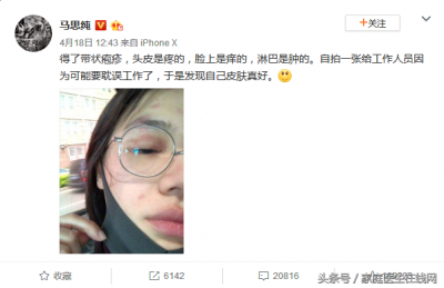 ​疱疹三天自愈的最佳方法 带状疱疹该怎么办？医生指出：大多数情况能自愈