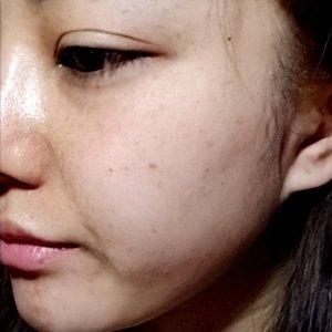 ​激光祛斑效果 祛斑一定要找对方法，小姐姐亲身经历激光祛斑，真的赢很大