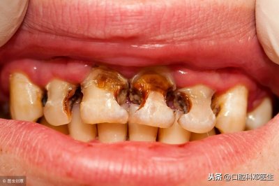 ​蛀牙怎么办才能彻底根除（做好这5件事，蛀牙跟你说拜拜！）