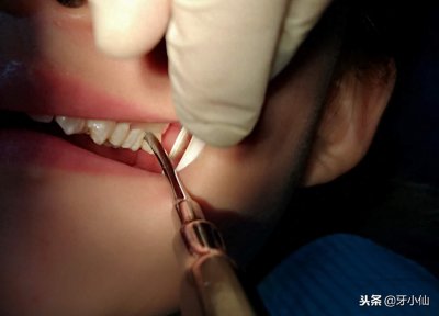 ​拔牙痛不痛？拔牙要多久？你关心问题的答案都在这里哦~
