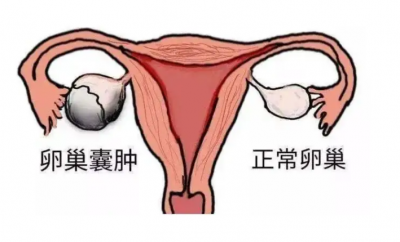 ​卵巢囊肿是什么原因引起的（卵巢囊肿很大几率是这几种原因，请对号入座）
