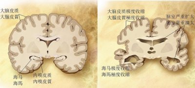 ​你对老年痴呆症了解多少？它与教育水平、睡眠，甚至体重密切相关