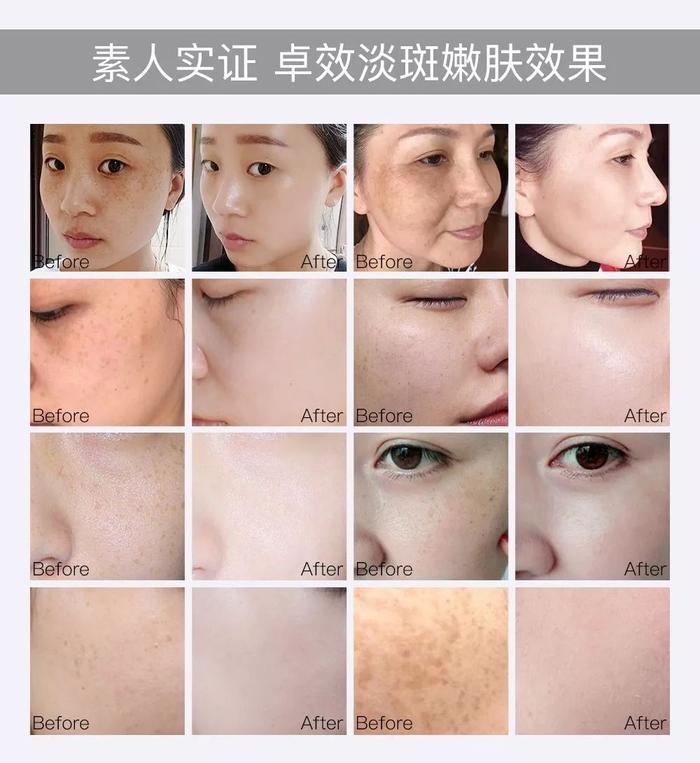 28天“色斑”全没了！她们都在这样做，网友惊呼：太神奇了！
