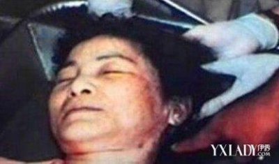 ​邓丽君去世后尸检照被曝光 脸部现巴掌印 死因大揭秘