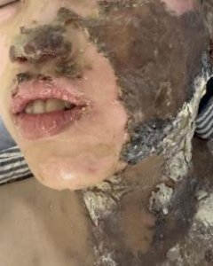 ​浙江温州一小学生课上被烧伤，预估数百万元治疗费谁负责？校方回应