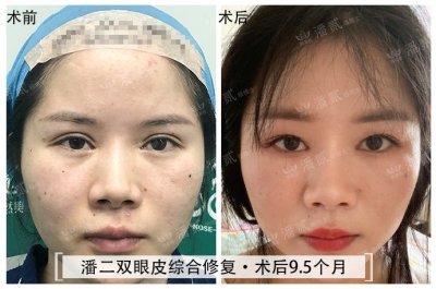 ​高难度双眼皮失败修复案例丨多次反复手术、损伤严重、四处被拒