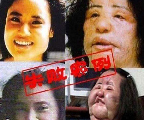 韩苗可整容前后的样子对比 那个超级失败的案例