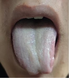 ​今天分享4种舌象案例：湿热、痰湿、淤血、气郁，赶快对照一下！
